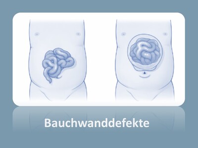 Schematische Darstellung von Bauchwanddefekten