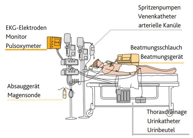 EKG-Elektroden Monitor Pulsoxymeter Thoraxdrainage Urinkatheter Urinbeutel Absauggerät Magensonde Spritzenpumpen Venenkatheter arterielle Kanüle Beatmungsschlauch Beatmungsgerät 1 5 3 2 4 EKG-Elektroden Monitor Pulsoxymeter Spritzenpumpen Venenkatheter arterielle Kanüle 12 ) 13 )))))))) INteNsIvstatIoN ((((((((((((()))))))))))((((((((((((()))))))))))((((((((((((()))))))))))(((((((((((((((((( der patIeNt auf der INteNsIvstatIoN 1 5 3 2 4 EKG-Elektroden Monitor Pulsoxymeter Thoraxdrainage Urinkatheter Urinbeutel Absauggerät Magensonde Spritzenpumpen Venenkatheter arterielle Kanüle Beatmungsschlauch Beatmungsgerät 1 5 3 2 4 12 ) 13 )))))))) INteNsIv((((())Nt auf dIn einer schematischen Darstellung eines Intensivbettes werden folgende Bereiche dem Patienten zugeordnet:  EKG-Elektroden, Monitor, Pulsoxymeter, Thoraxdrainage, Urinkatheter, Urinbeutel, Absauggerät, Magensonde, Spritzenpumpen, Venenkatheter, arterielle Kanüle, Beatmungsschlauch, Beatmungsgerät, Thoraxdrainage, Urinkatheter, Urinbeutel, Beatmungsschlauch, Beatmungsgerät, Absauggerät, Magensonde