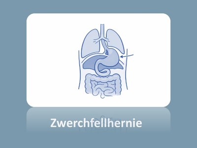Schematische Darstellung einer Zwerchfellhernie