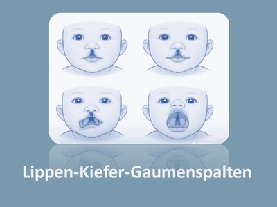 Schematische Darstellung Lippen-Kiefer-Gaumenspalten